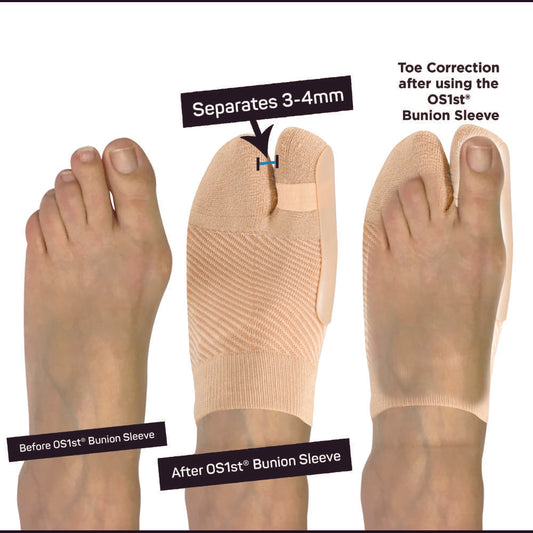 Bunion Bracing Sleeve (HV3) - Natural